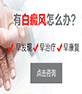 白癜风预约挂号